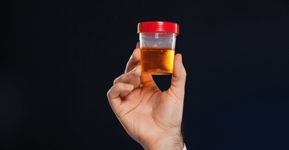 Hematuria blood in urine
