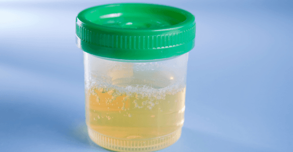 Foamy Urine and Kidney Problems – Dr. Satyanarayana Garre