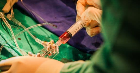 Perm Catheterization for Dialysis