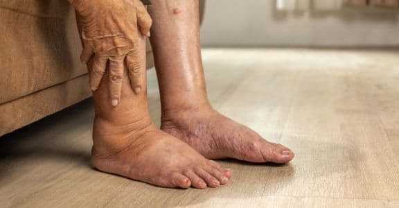 Swelling in Feet Face and Ankles Kidney Disease Signs