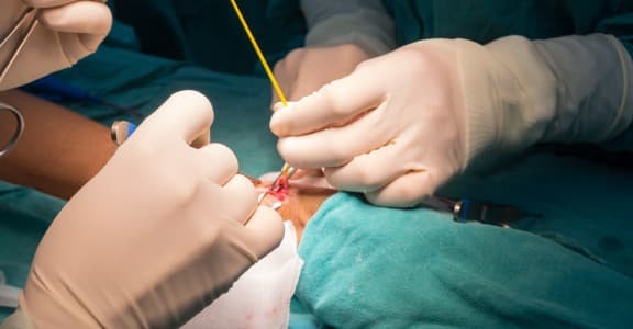 AV fistula for dialysis