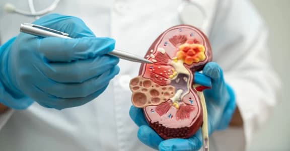 9 Early Kidney Stone Symptoms in Men vs Women