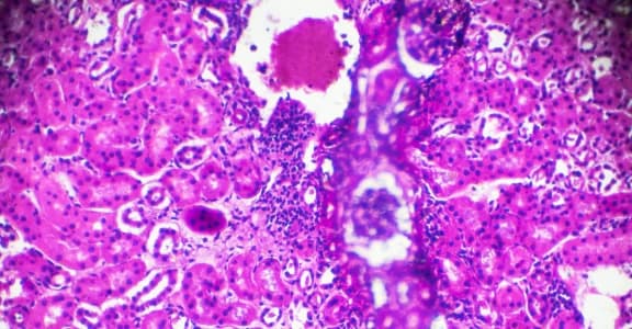 Acute Pyelonephritis Warning Signs: A Nephrologist’s Guide to Timely Treatment